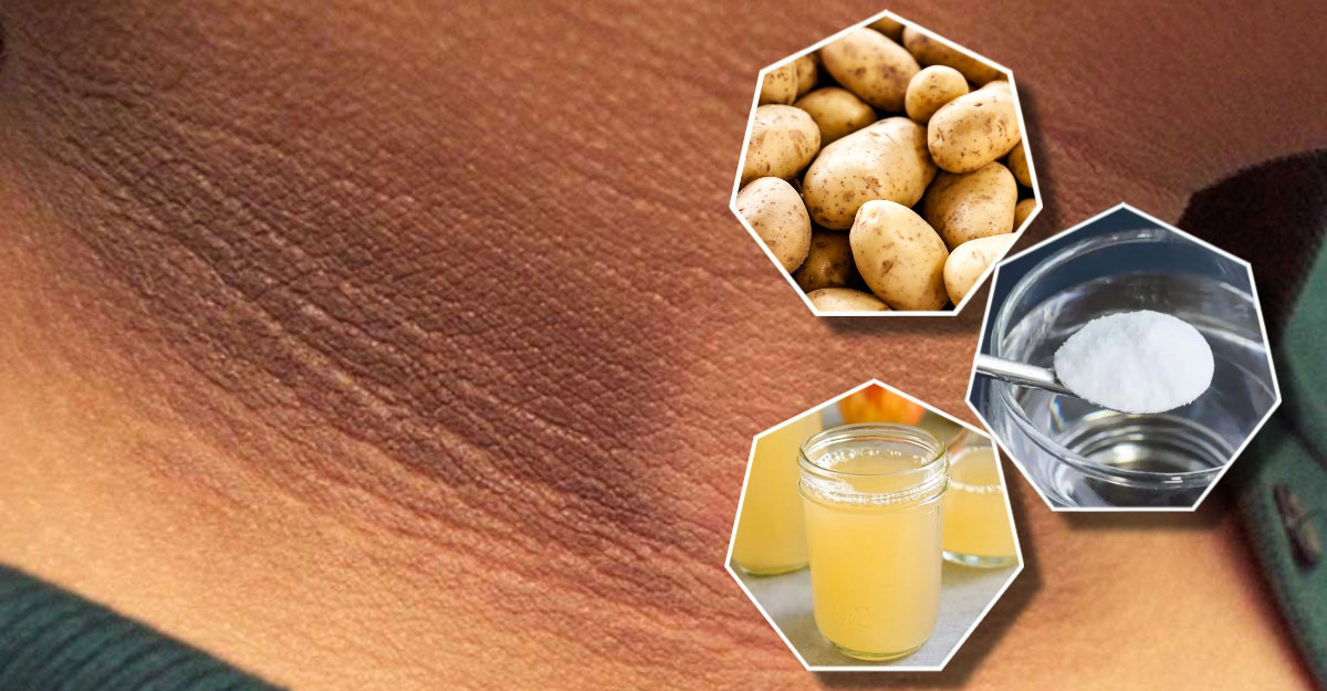 ঘাড়ের কালো দাগ কীভাবে দূর করবেন