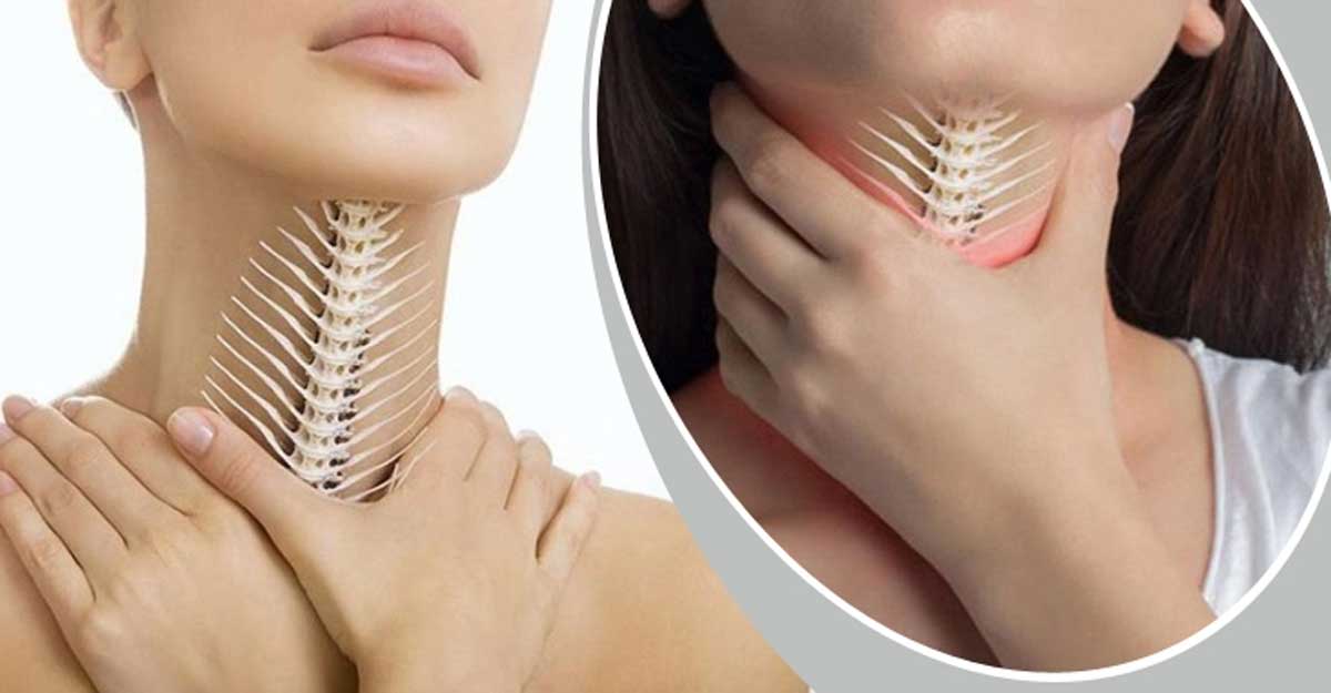 গলায় মাছের কাটা বিঁধলে তাৎক্ষণিক যা করবেন