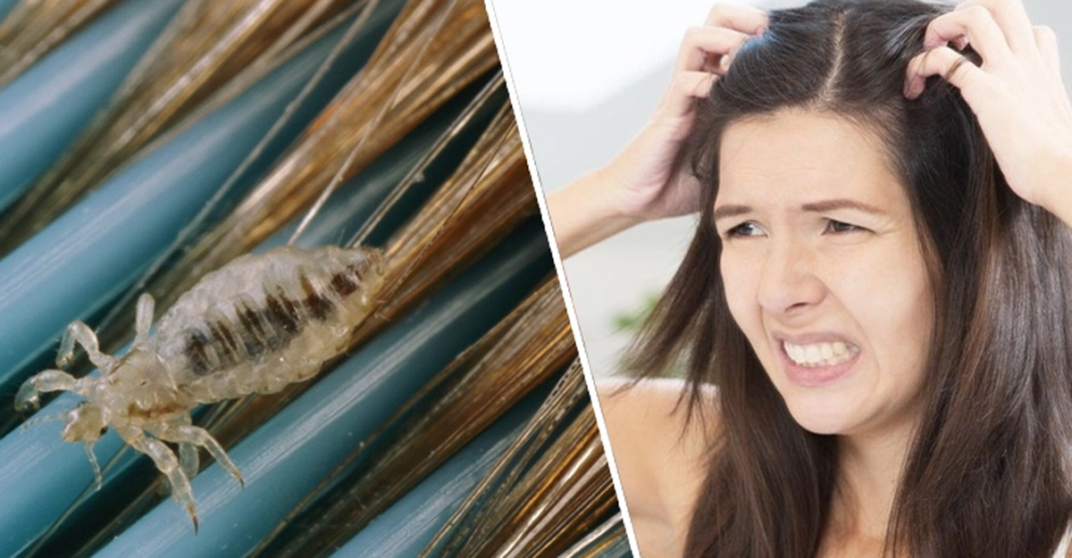 ঘরোয়া উপায়ে উকুন দূর করার উপায় জানালেন ডাক্তার তাসনিম জারা