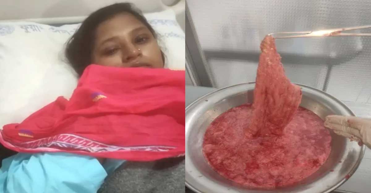 নারীর পেটে ব্যান্ডেজ রেখে সেলাই, ৭ মাস পর অপসারণ