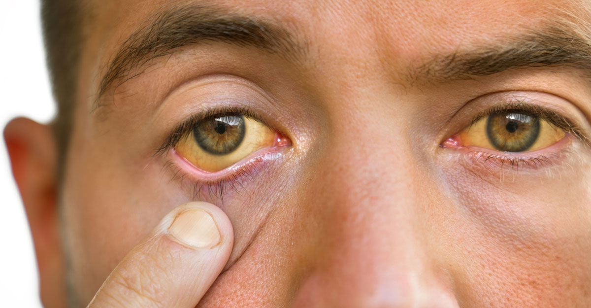 জন্ডিসের চিকিৎসায় ভরসা রাখুন এসব পাতায়