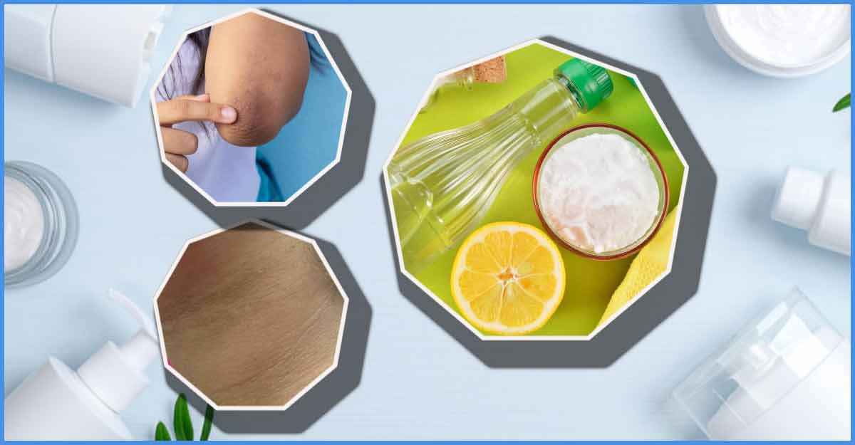 ঘাড়-কনুইয়ের কালো দাগ দূর করুন মাত্র ১৫ মিনিটে