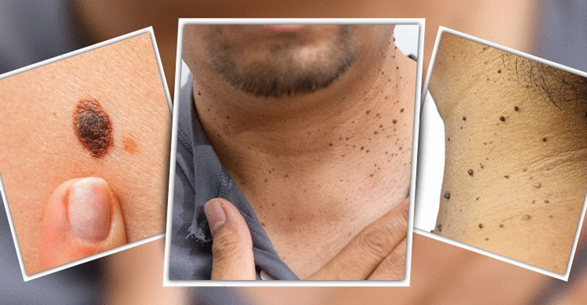 আঁচিল দূর করার ঘরোয়া উপায়