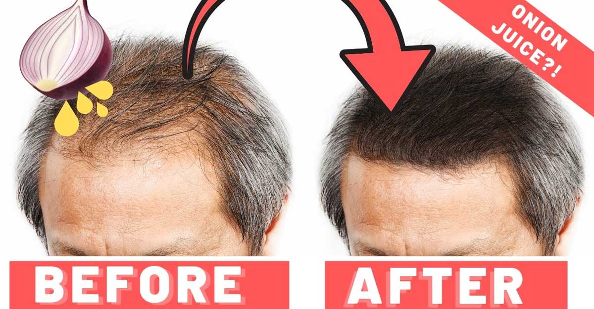 টাকেও চুল গজাবে, মানলে এই নিয়ম