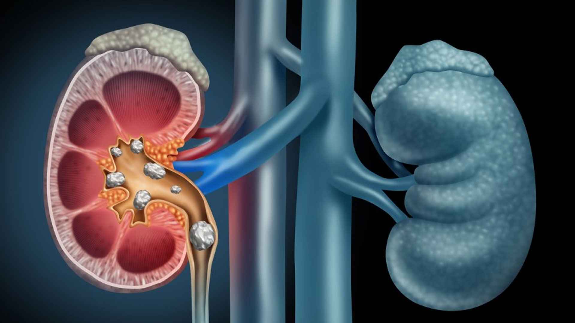 ক্যালশিয়ামের ওষুধ বেশি খেলে কি কিডনিতে পাথর জমতে পারে?