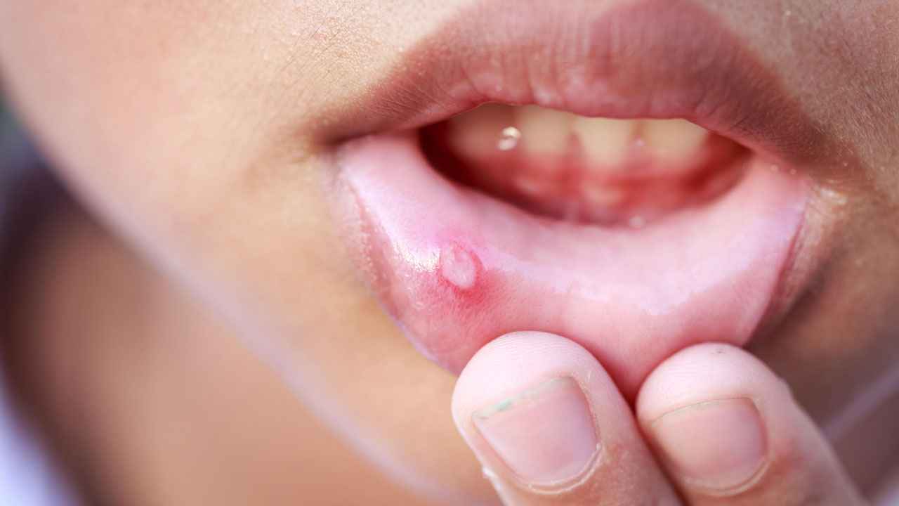 মুখে ঘা হলে কী করণীয়