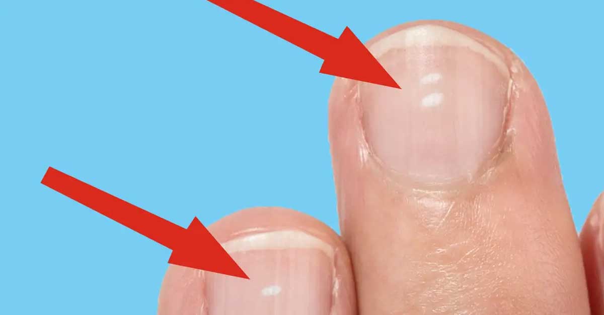 নখ দেখে রোগ চেনার উপায়