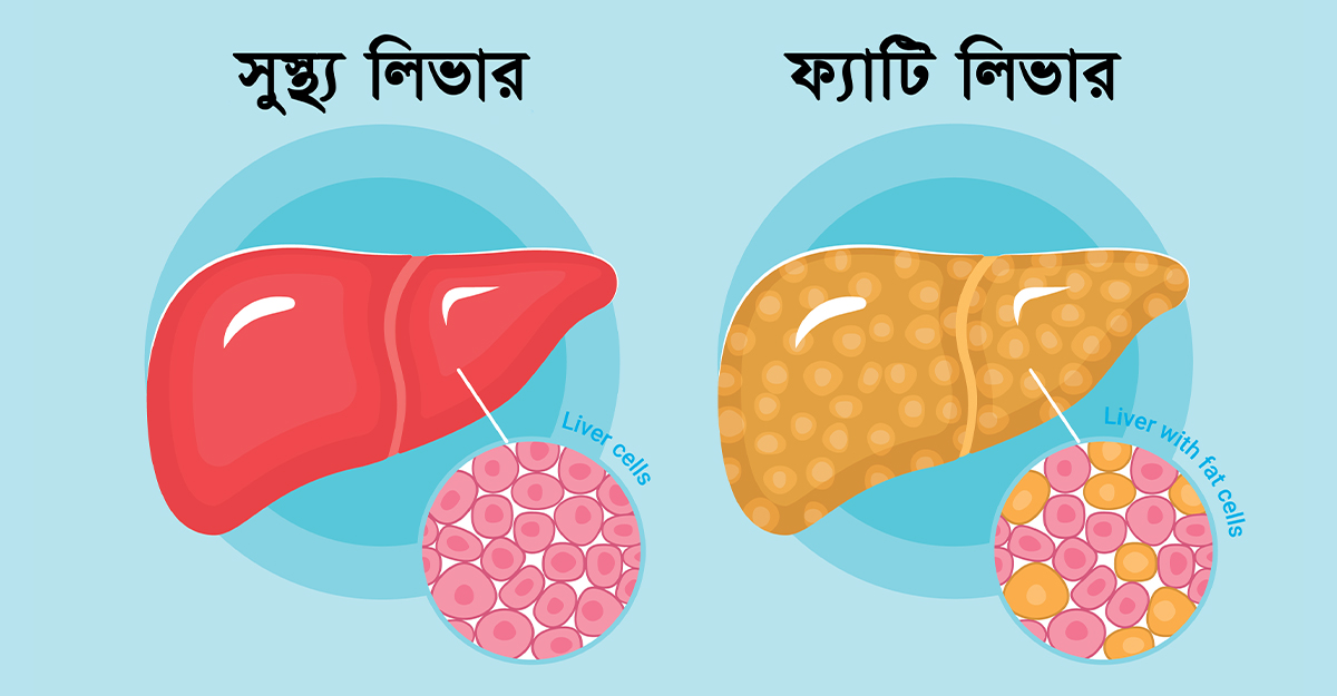 fatty-liver