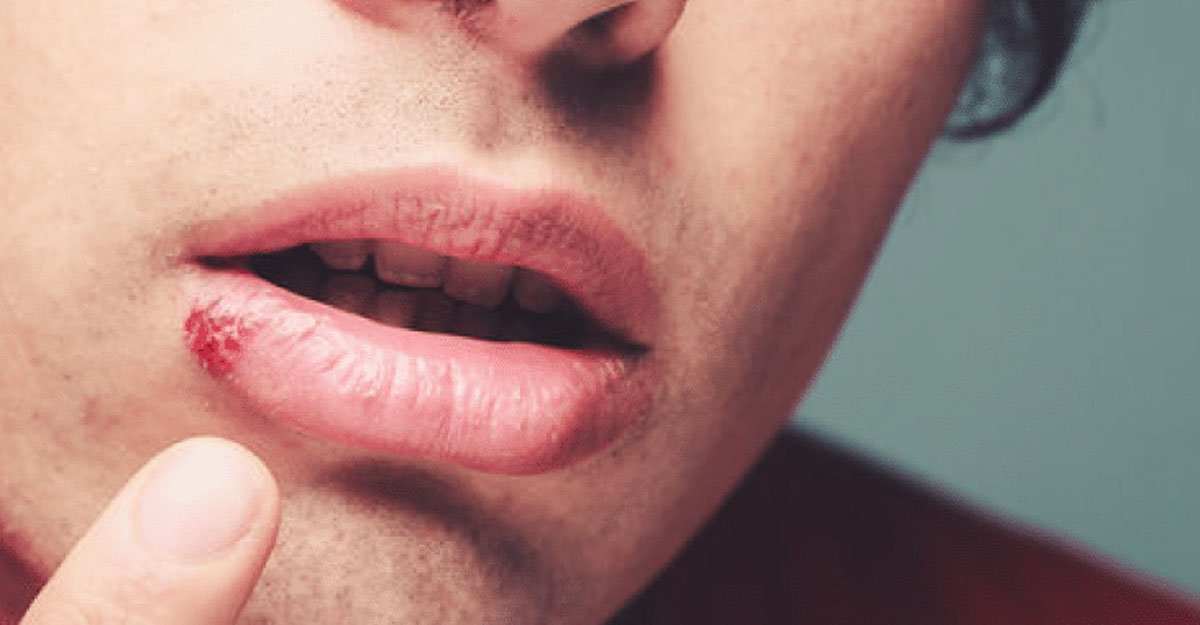 fever blister