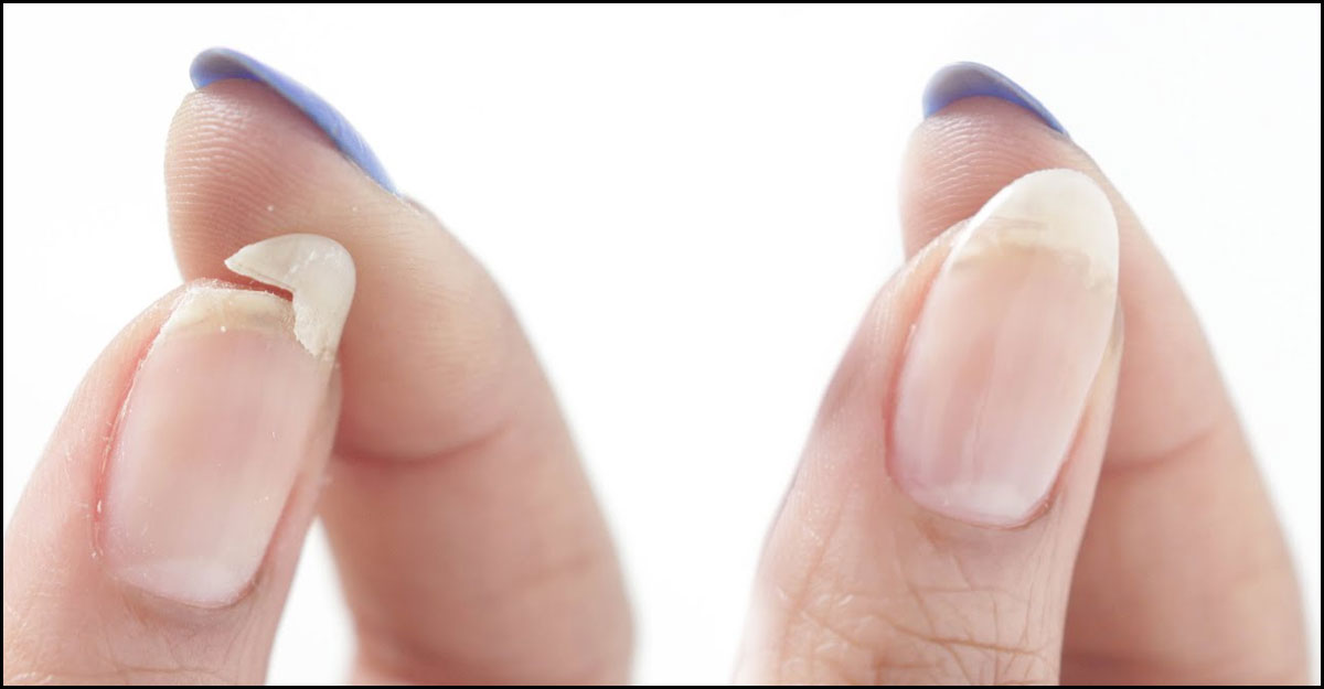 নখ বারবার ভেঙে যায়? কাজে লাগান এসব ঘরোয়া উপায়