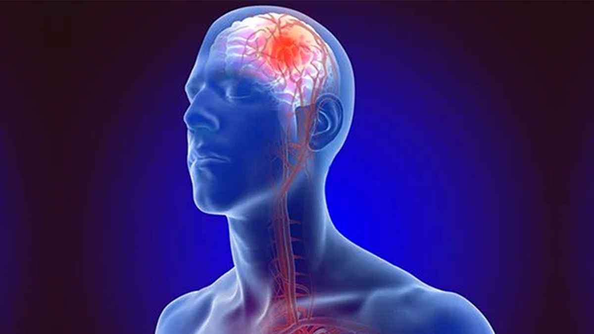 যেসব কারণে স্ট্রোক হয় ও এর লক্ষণ