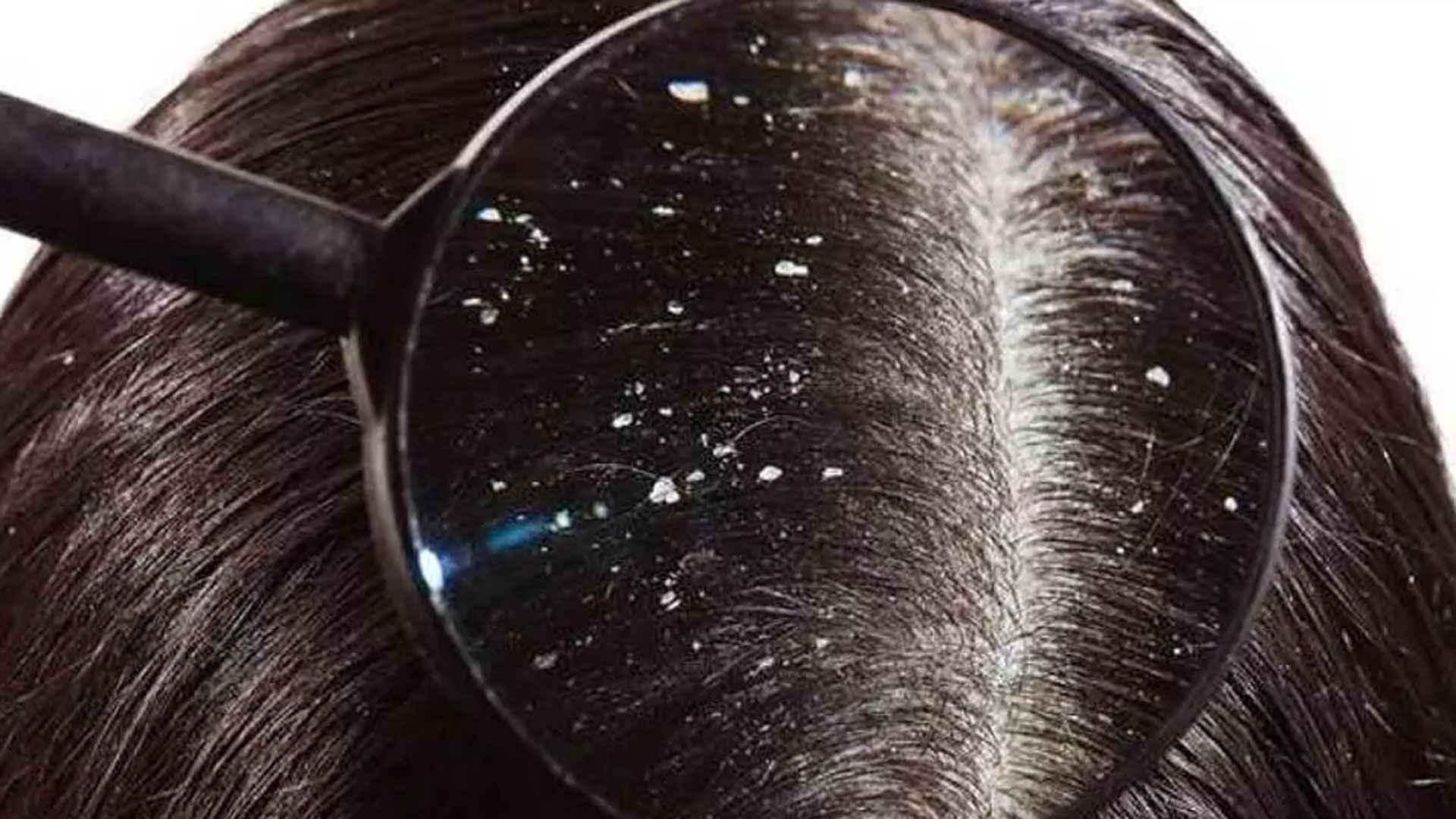 শীতে খুশকি থেকে বাঁচার উপায়