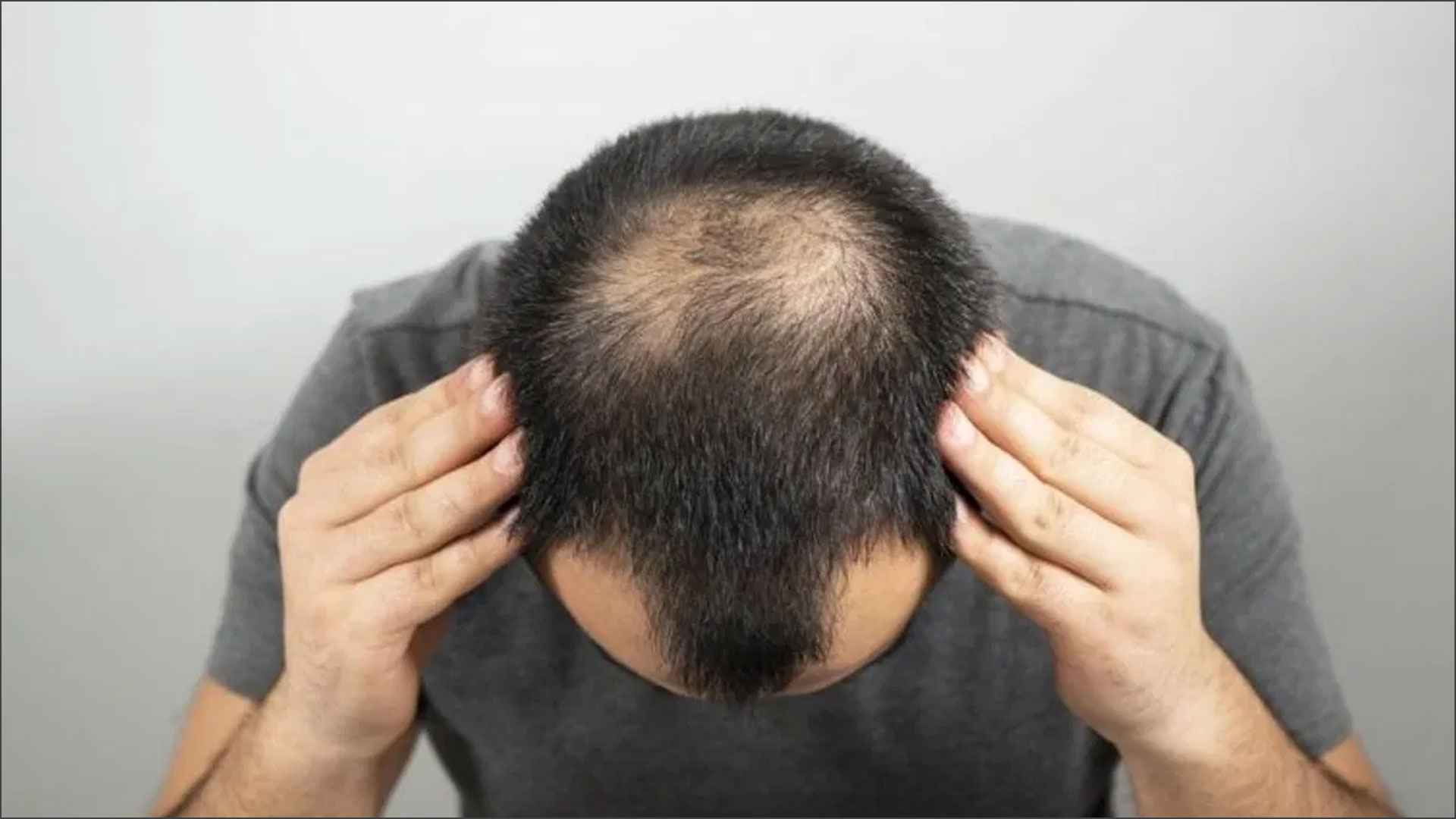 টাকমাথায় চুল গজানোর সহজ ৪ উপায় 