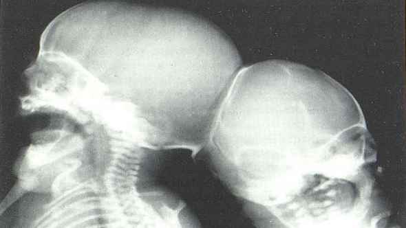 জোড়া লাগানো দুই বোনের বিয়ের হুকুম কী