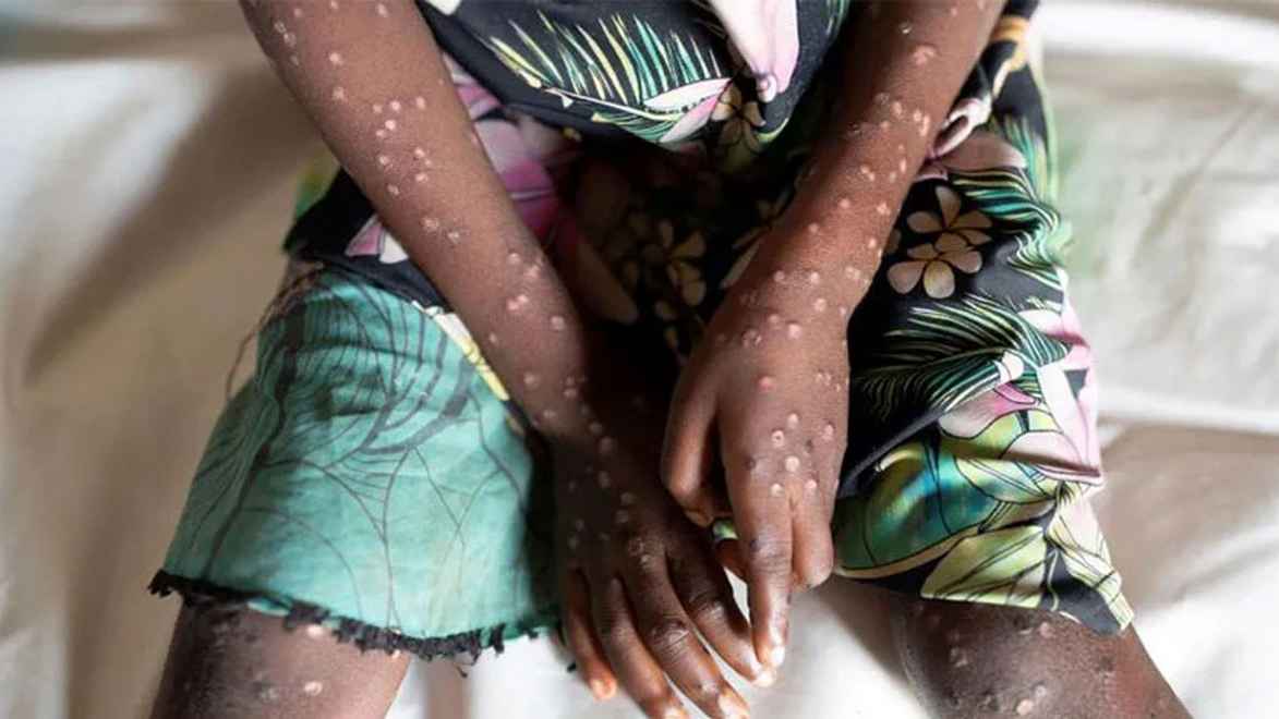 দ্রুত ছড়িয়ে পড়ছে মাঙ্কিপক্স, বিশ্বজুড়ে জরুরি অবস্থা জারি