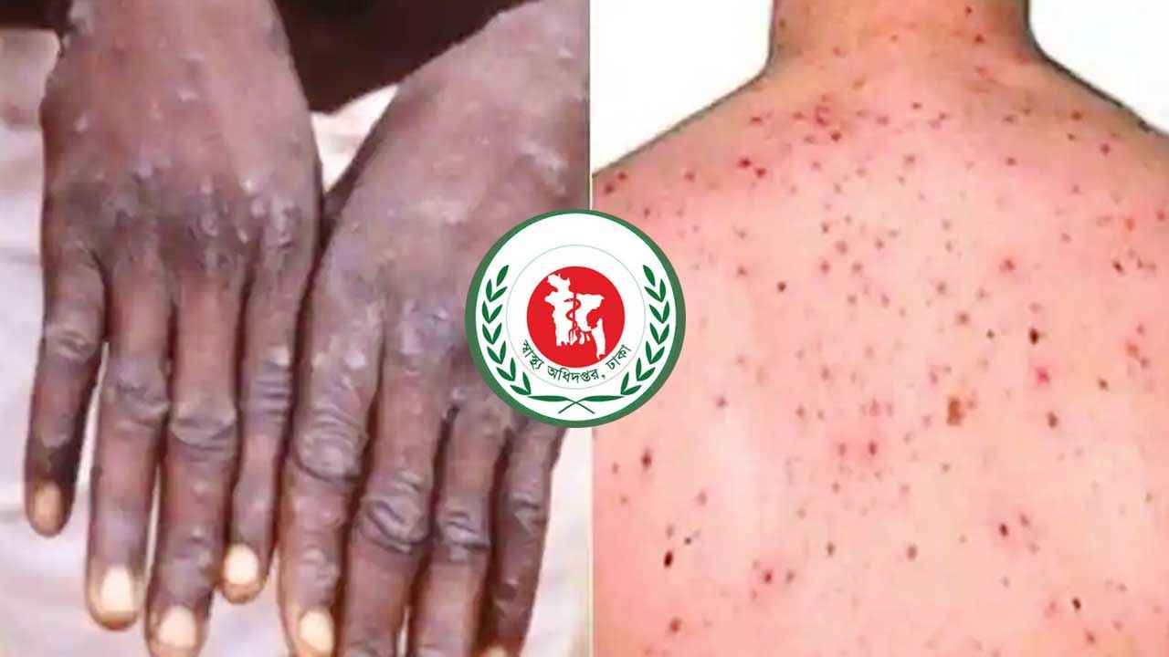 মাঙ্কিপক্স: স্বাস্থ্য অধিদফতরের হটলাইন চালু
