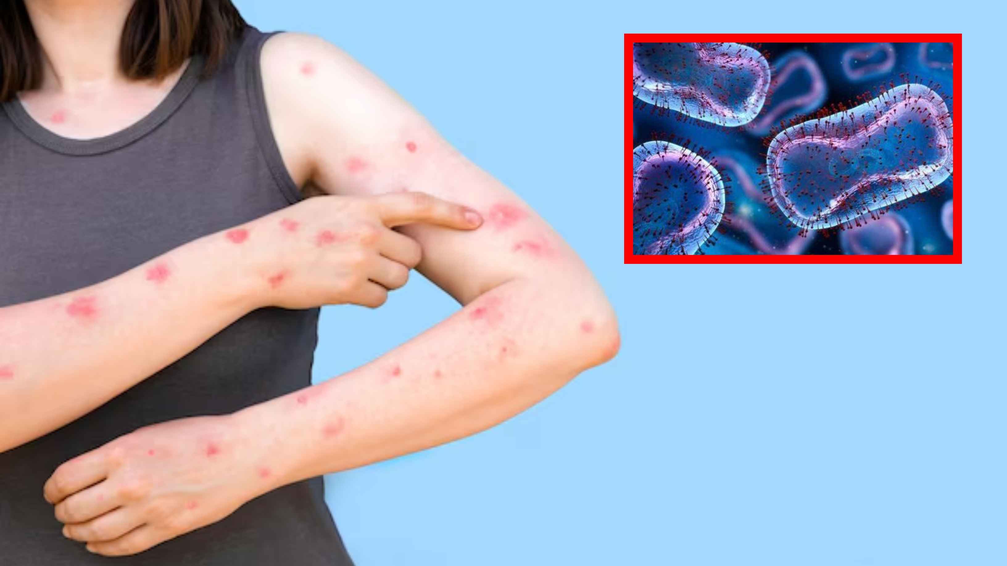 মাঙ্কিপক্স কী, এর লক্ষণ ও প্রতিরোধের উপায় জানুন