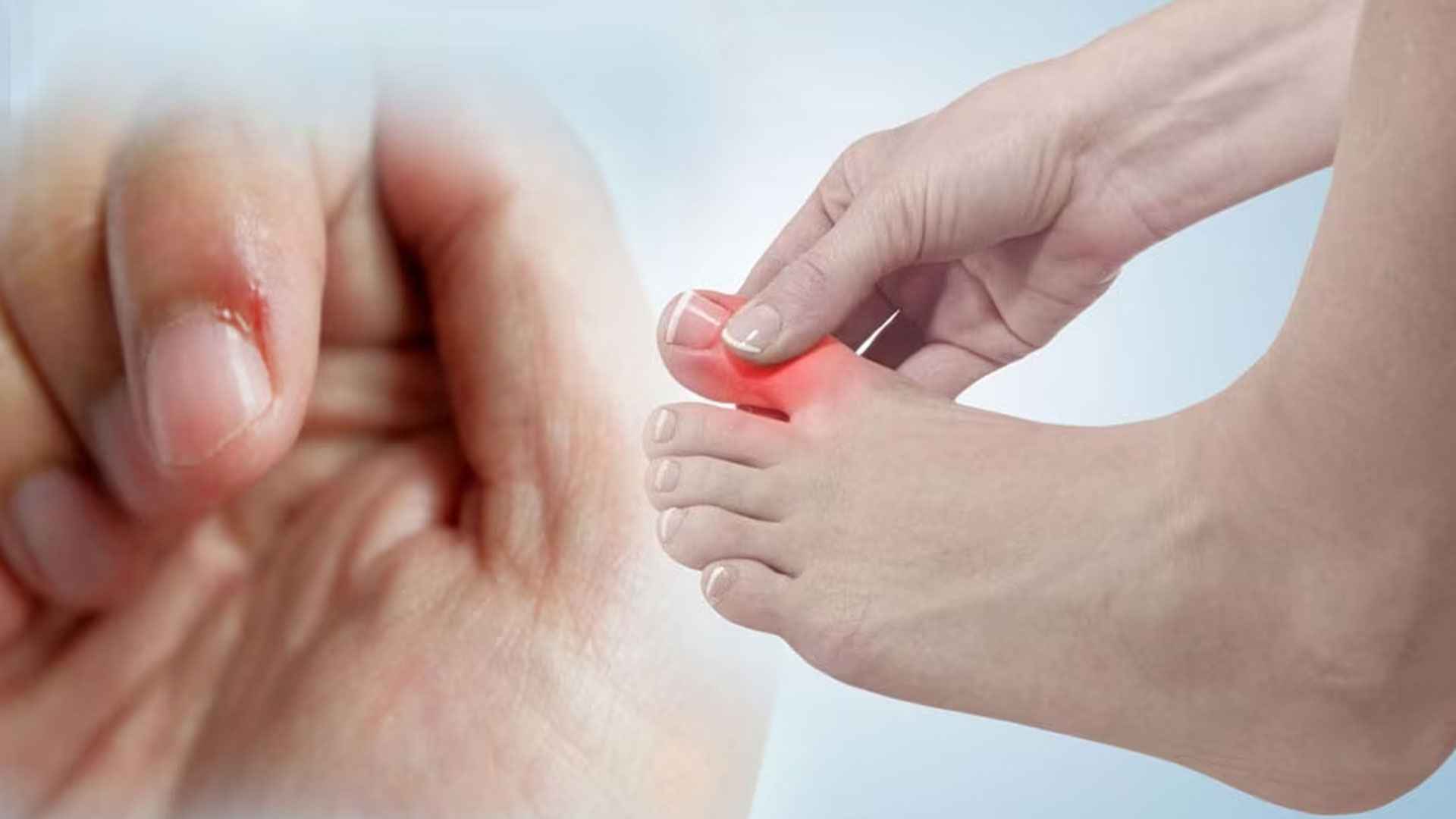 নখকুনি ভালো করার উপায় জানুন