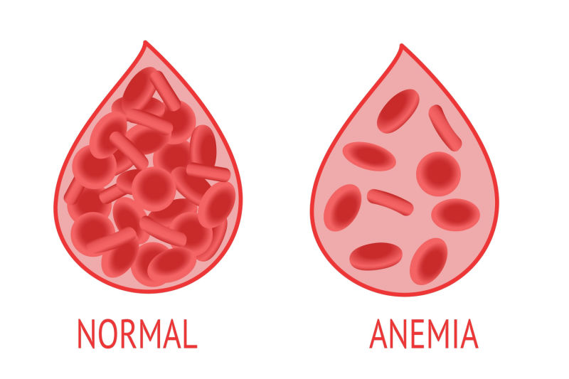 anemia3 anemia3