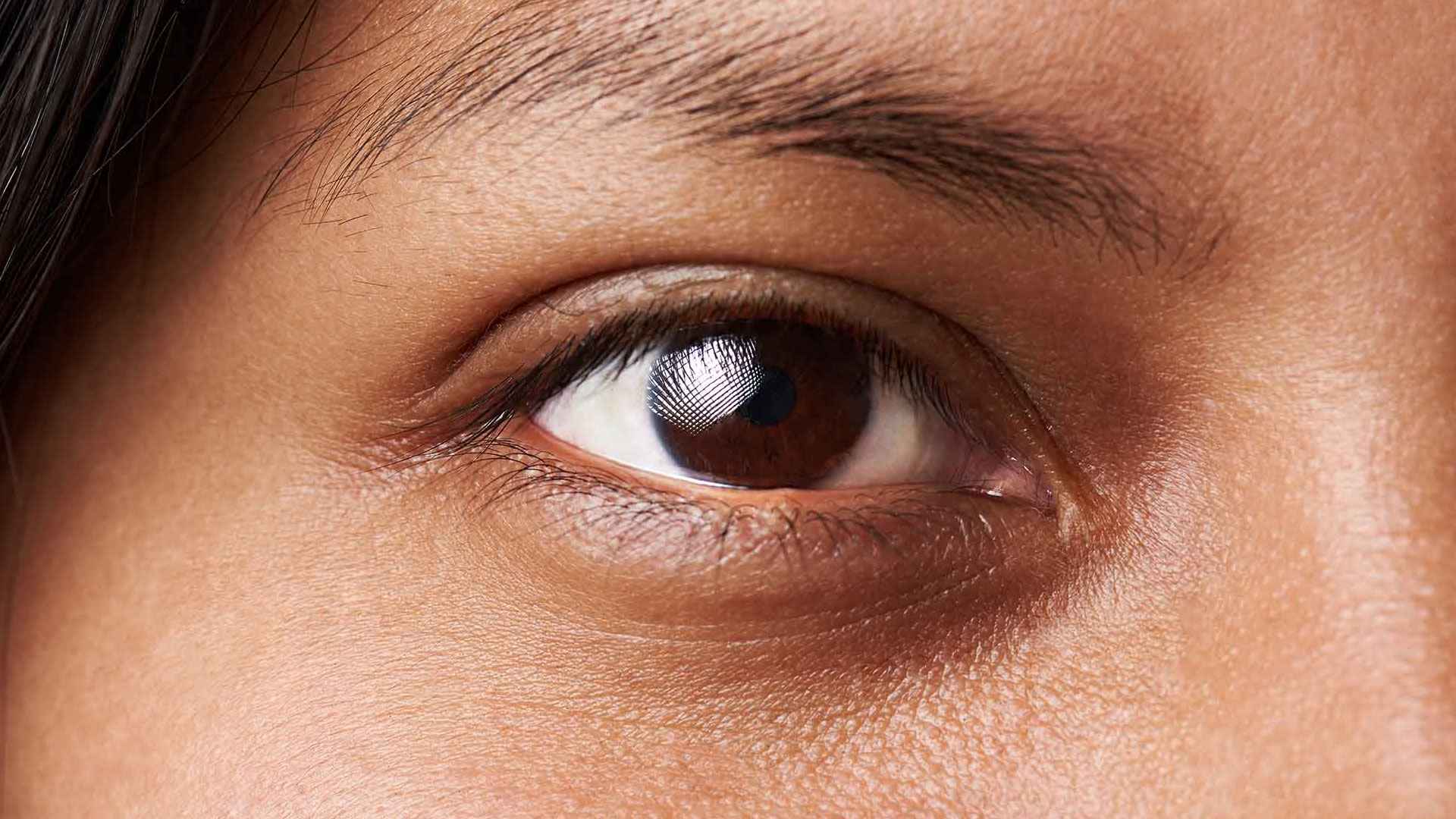 ডার্ক সার্কেল কেন হয়? দূর করতে করণীয়