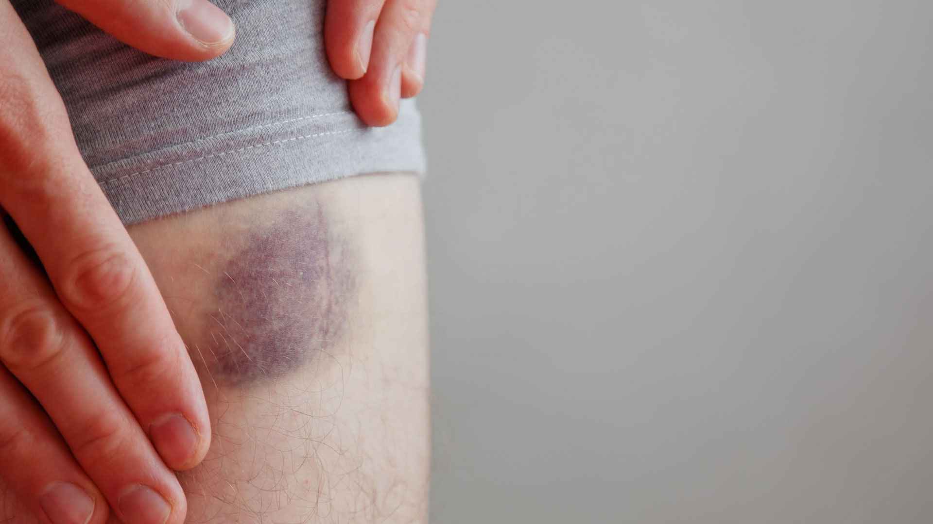 সামান্য আঘাতেই ত্বকে কালশিটে দাগ পড়া কীসের ইঙ্গিত?