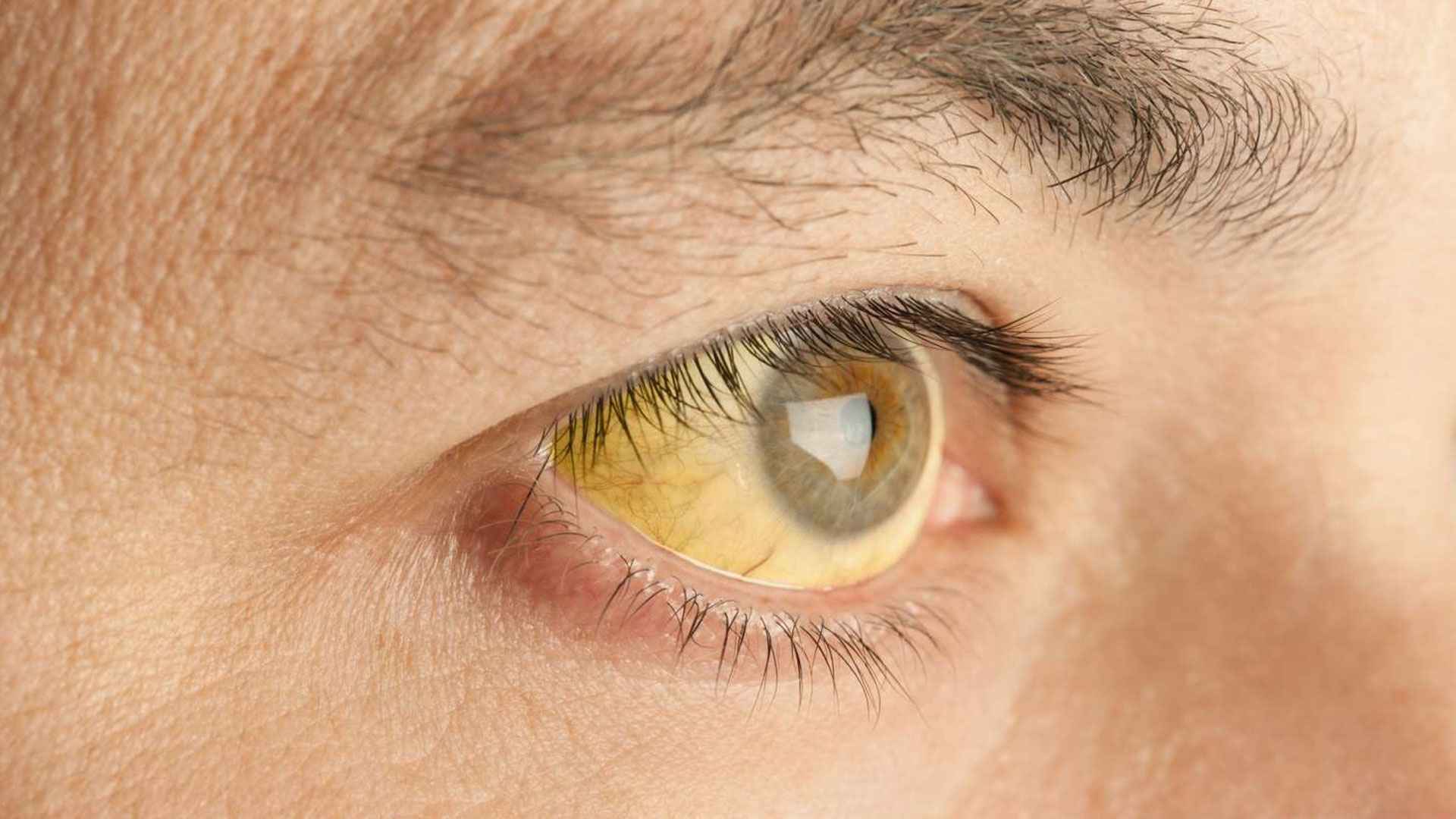 জন্ডিস হলে কী খাবেন, কী খাবেন না