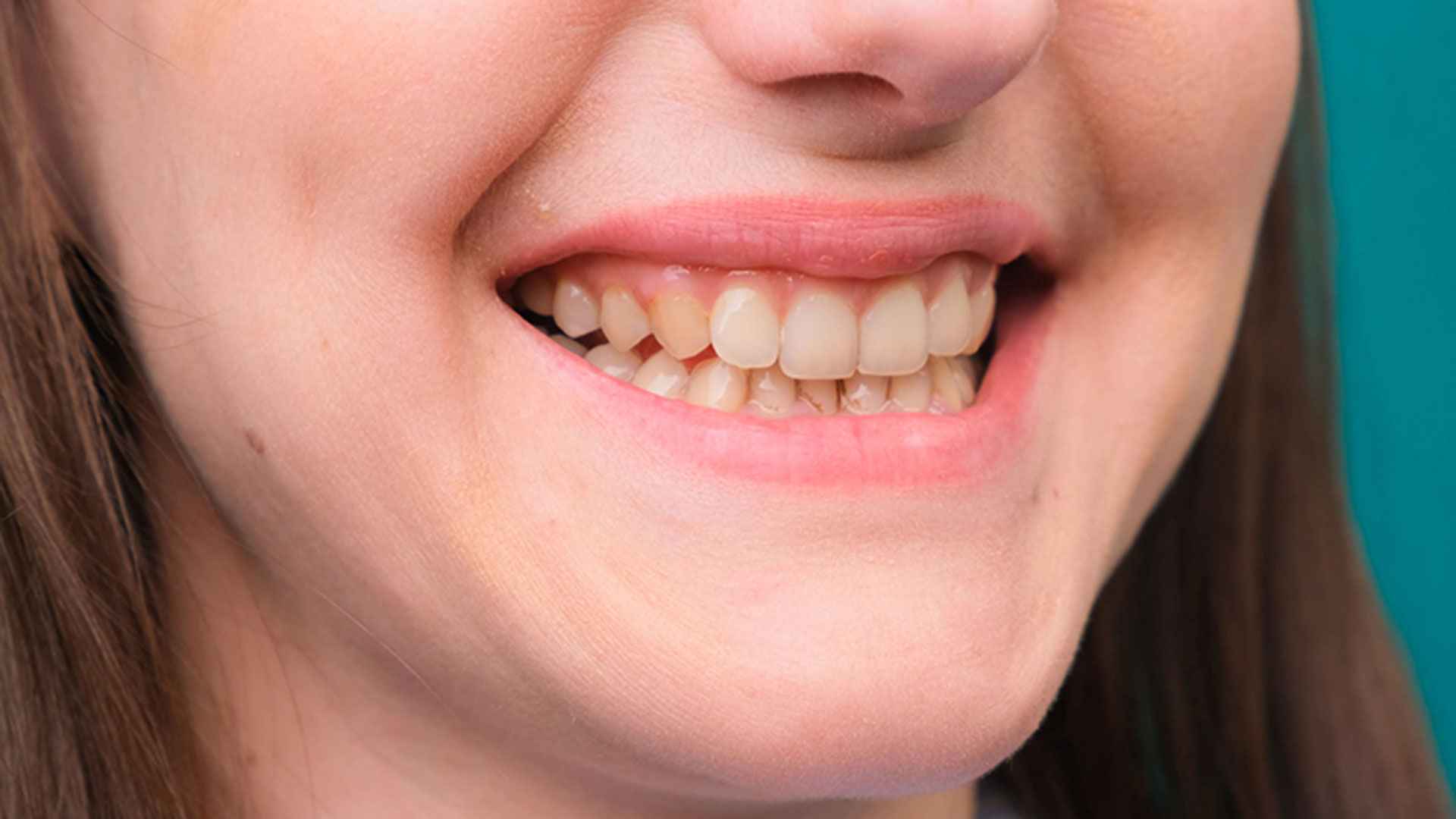 দাঁতের হলদেটে ভাবের জন্য দায়ী যেসব খাবার