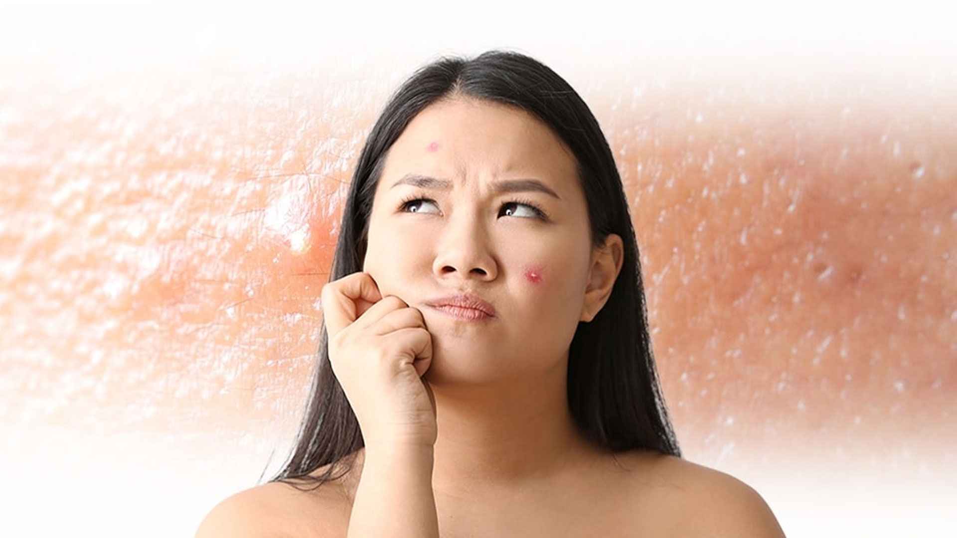 ৭ দিনে ব্রণ দূর করার উপায়