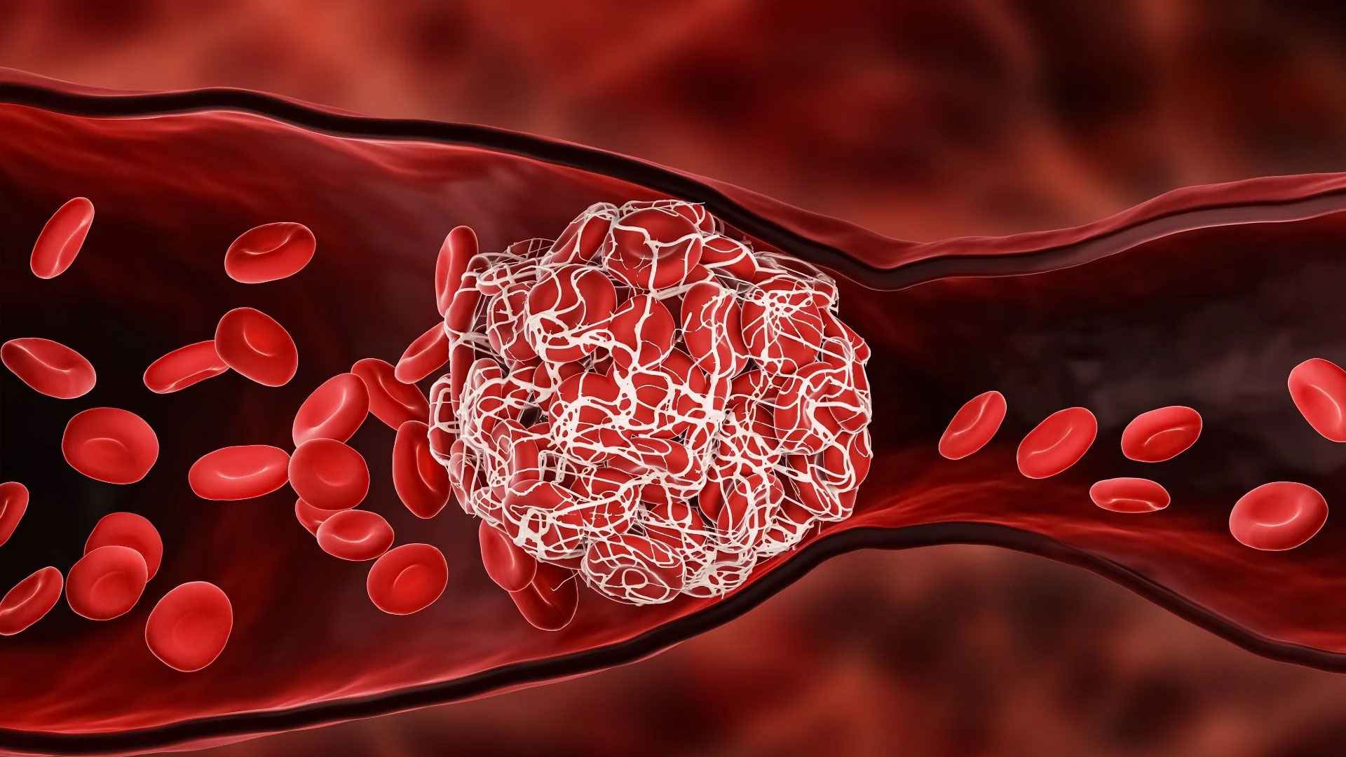 রক্ত জমাটের ৩ লক্ষণ বোঝে না অনেকেই