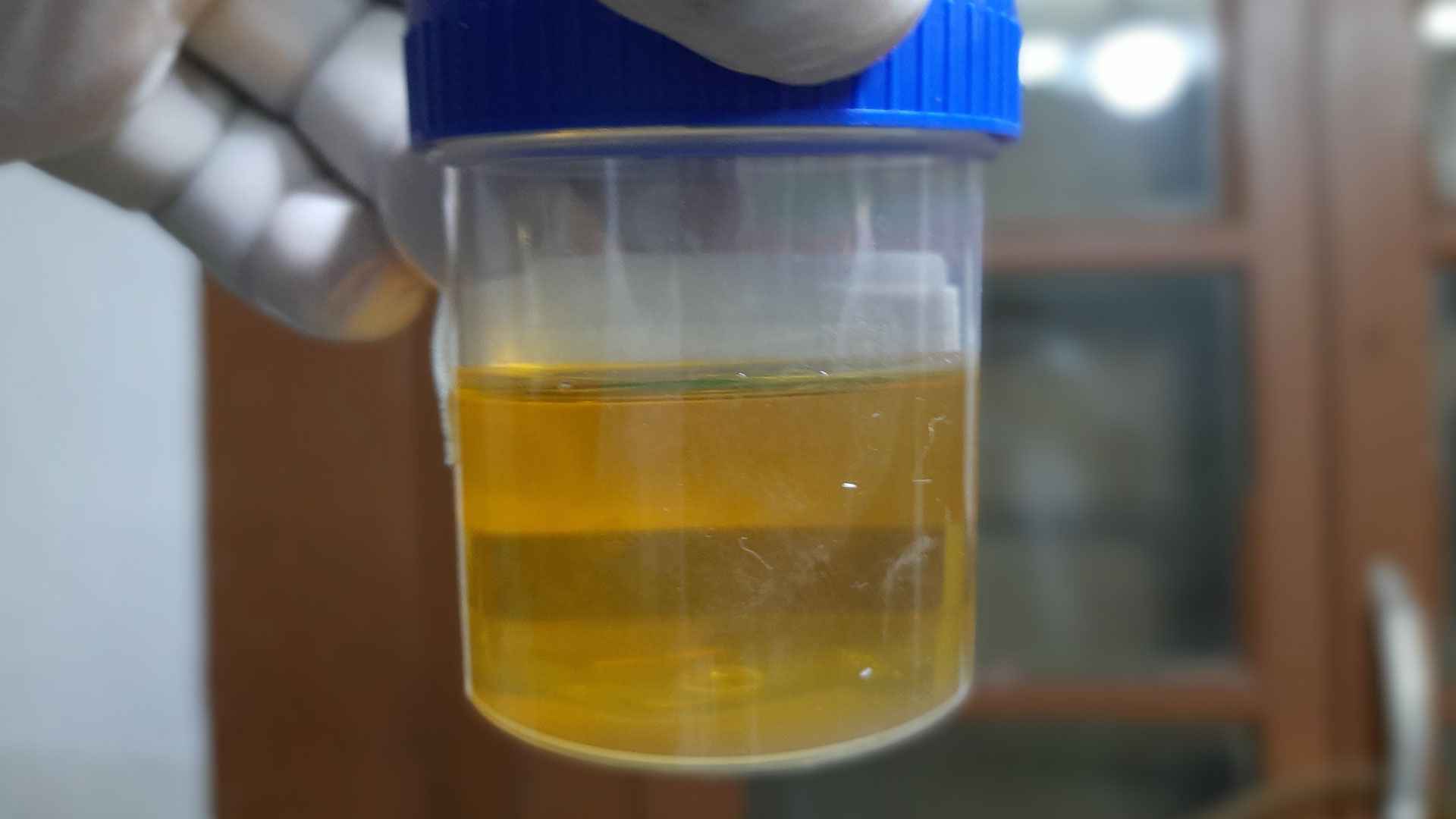 পর্যাপ্ত পানি পানের পরও প্রস্রাব হলুদ হয় যে কারণে