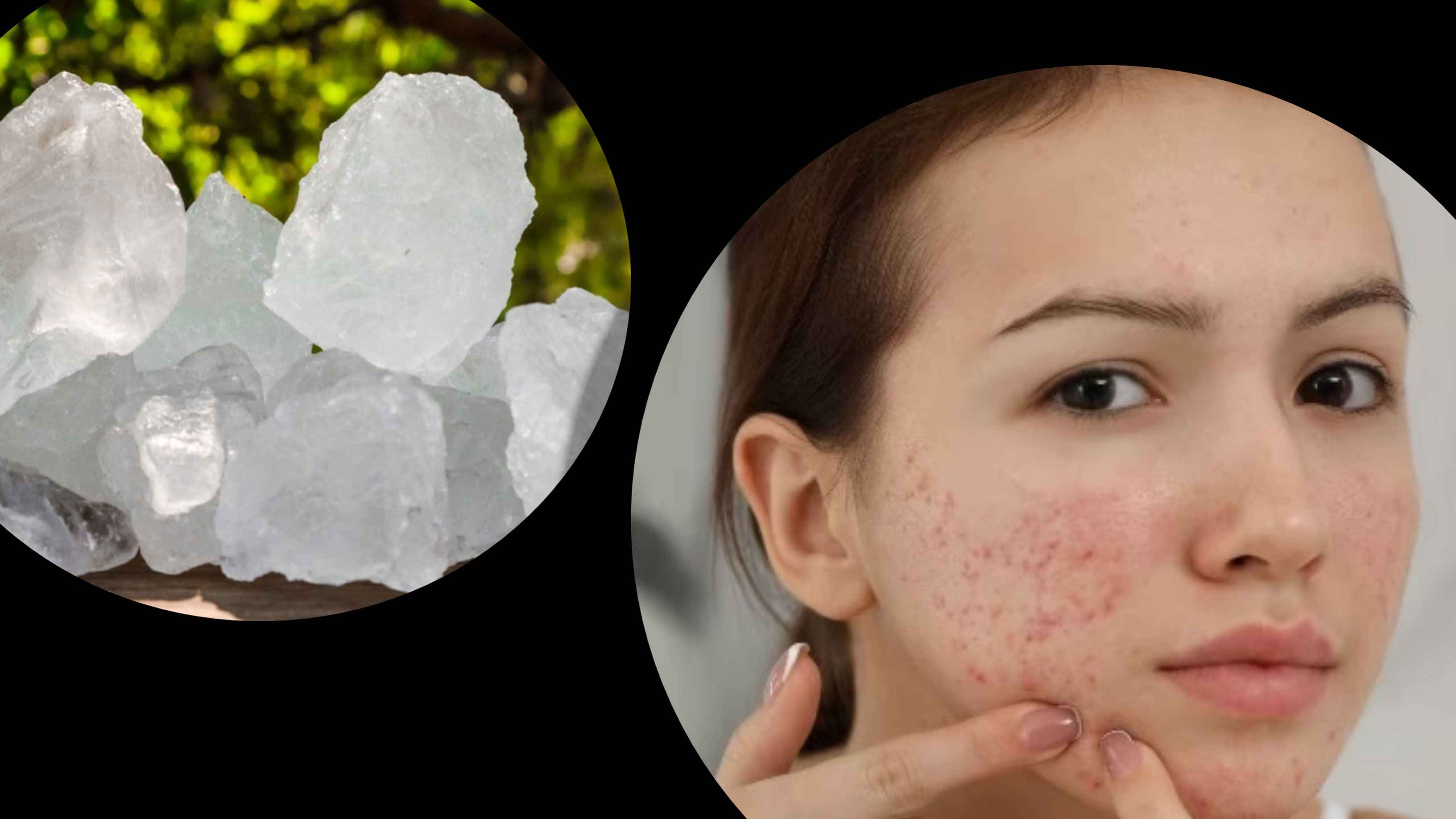 ত্বকের জেল্লা বাড়ায় ফিটকিরি, কমায় ব্রণ