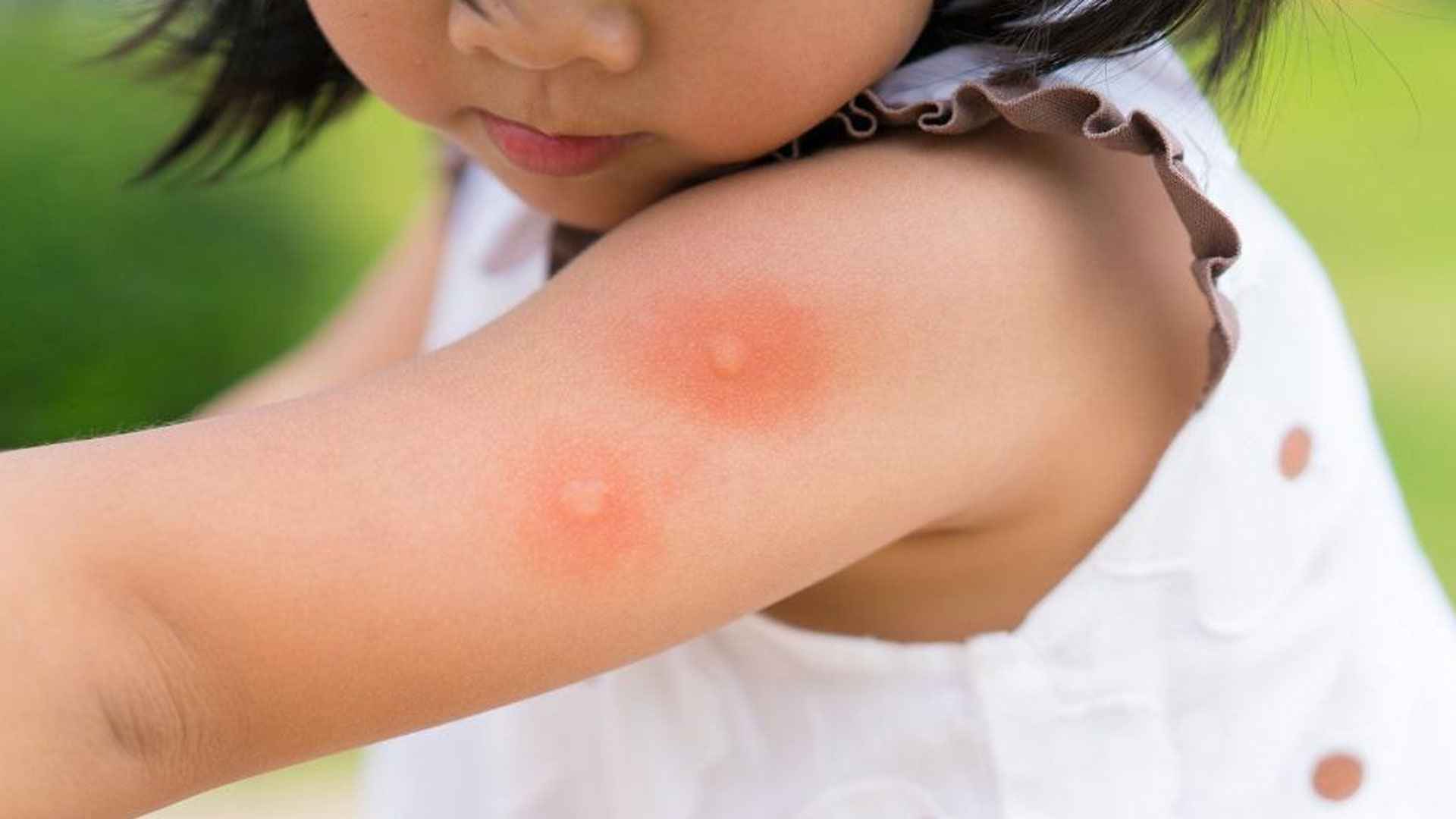 মশার কামড়ে গায়ে চাকা চাকা দাগ হলে কী করবেন?