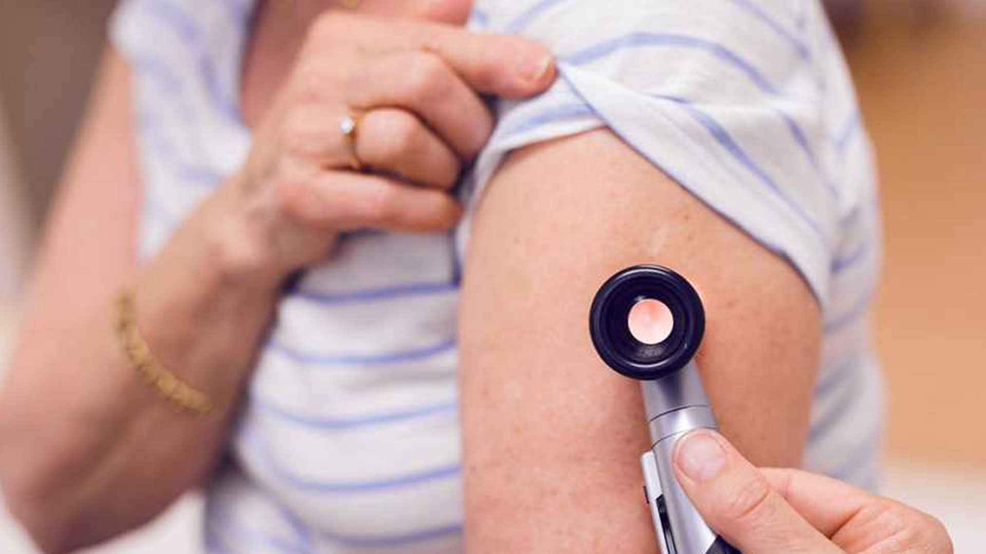 আঁচিলের সংখ্যা বৃদ্ধি হতে পারে ক্যানসারের লক্ষণ