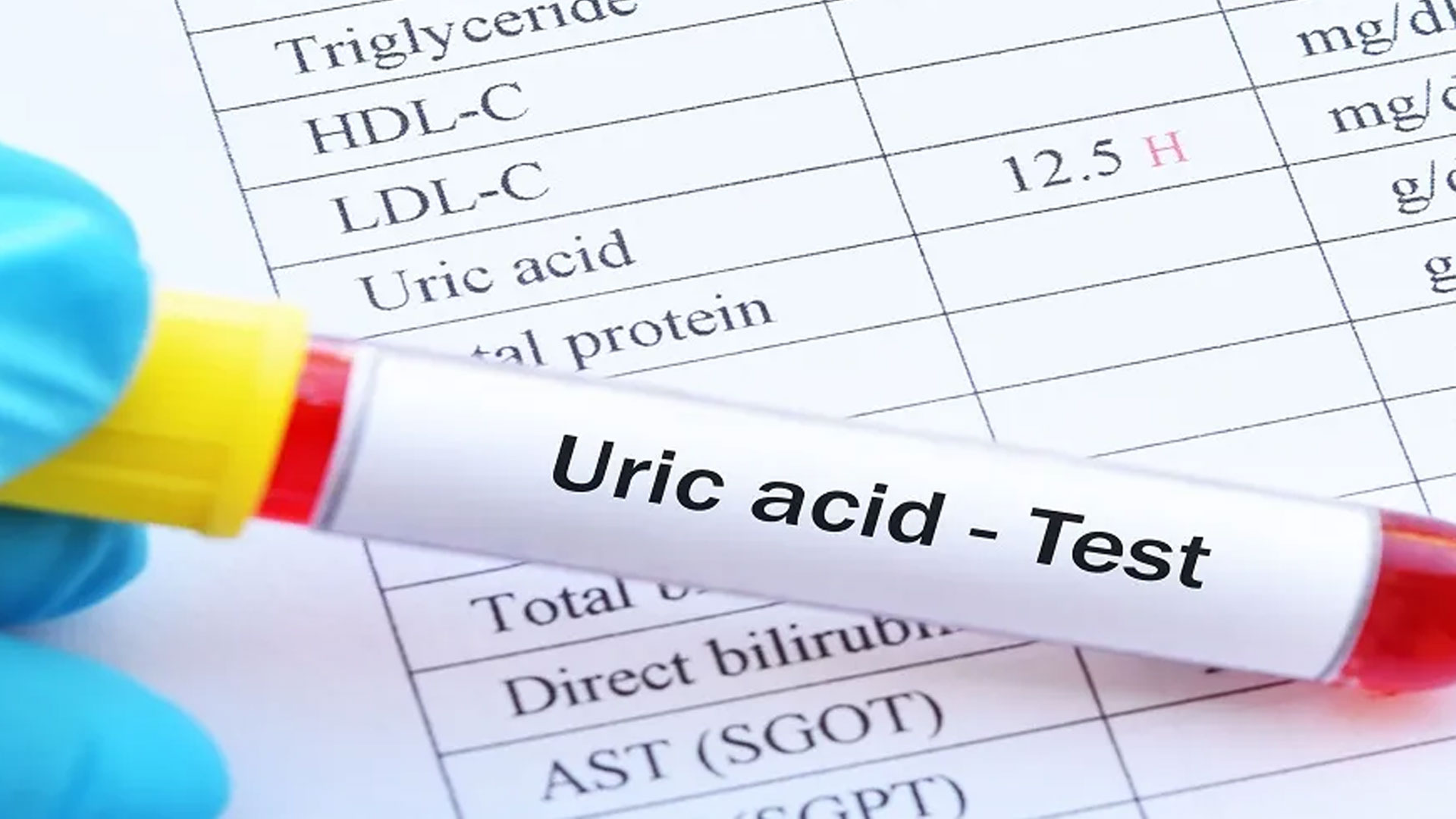 uric-acid2 uric-acid2