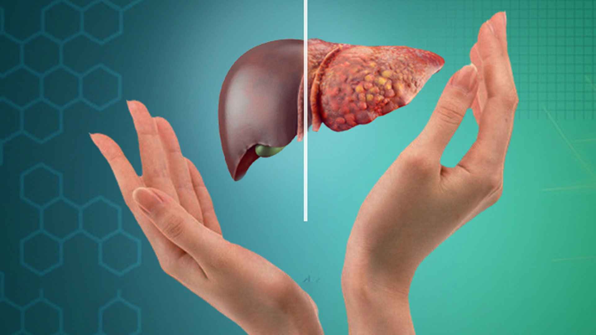 ফ্যাটি লিভার: লক্ষণ ও করণীয় জানুন 