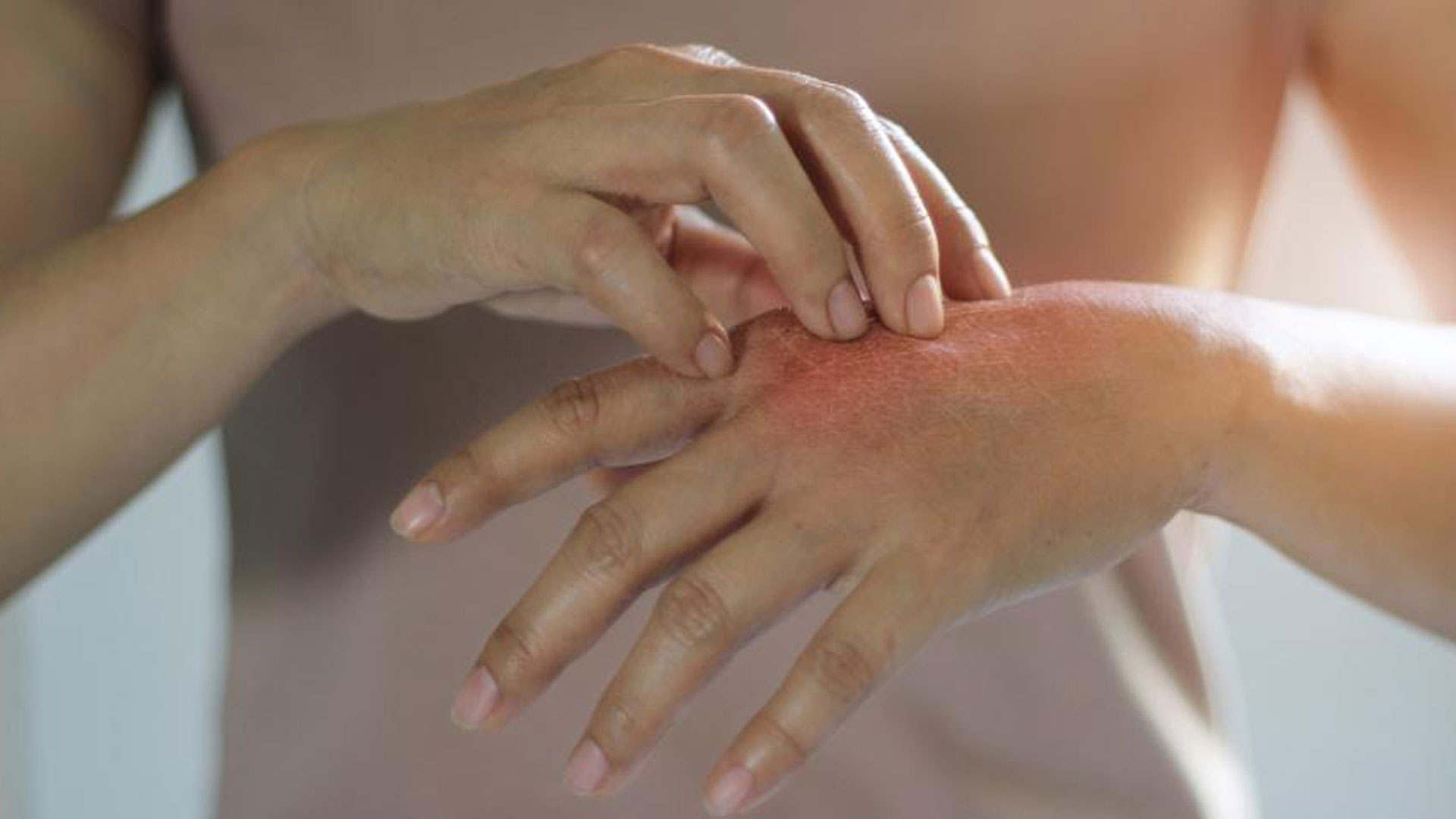 allergi4