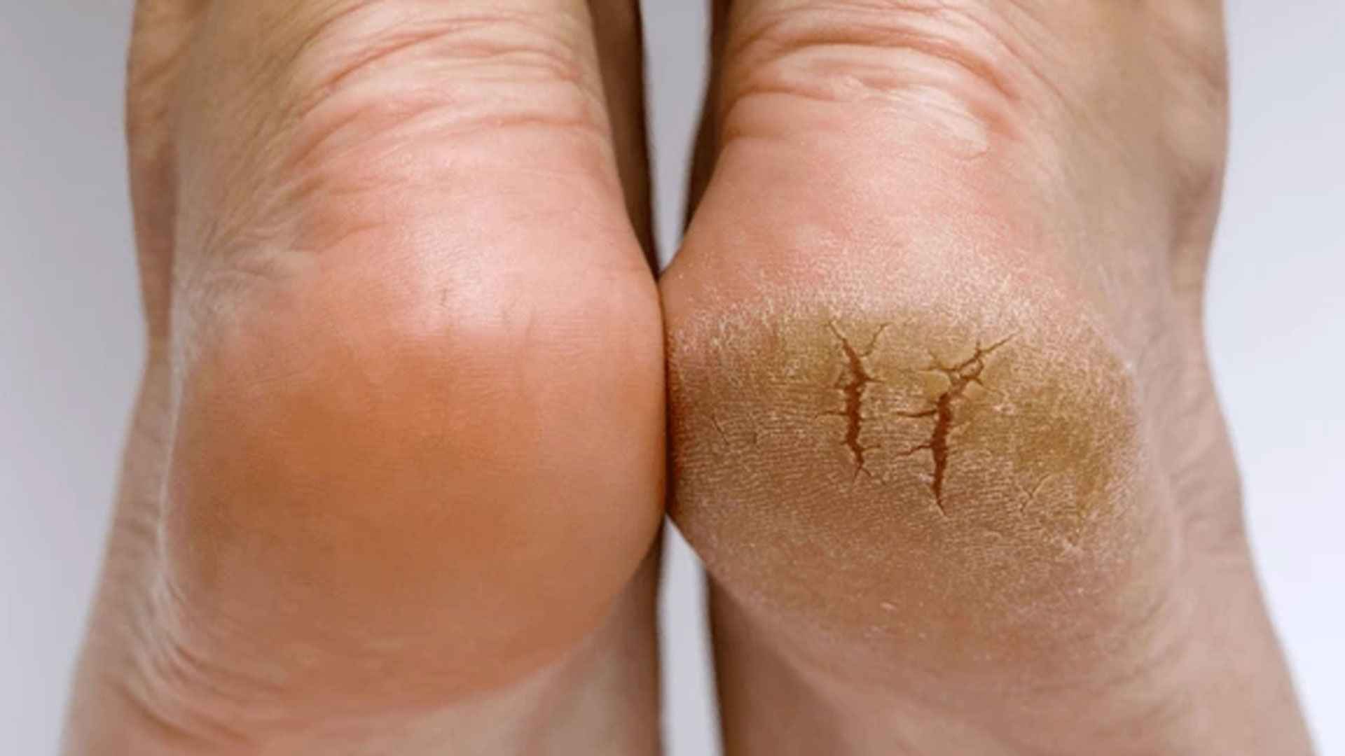 পা ফাটা থেকে মুক্তির উপায়