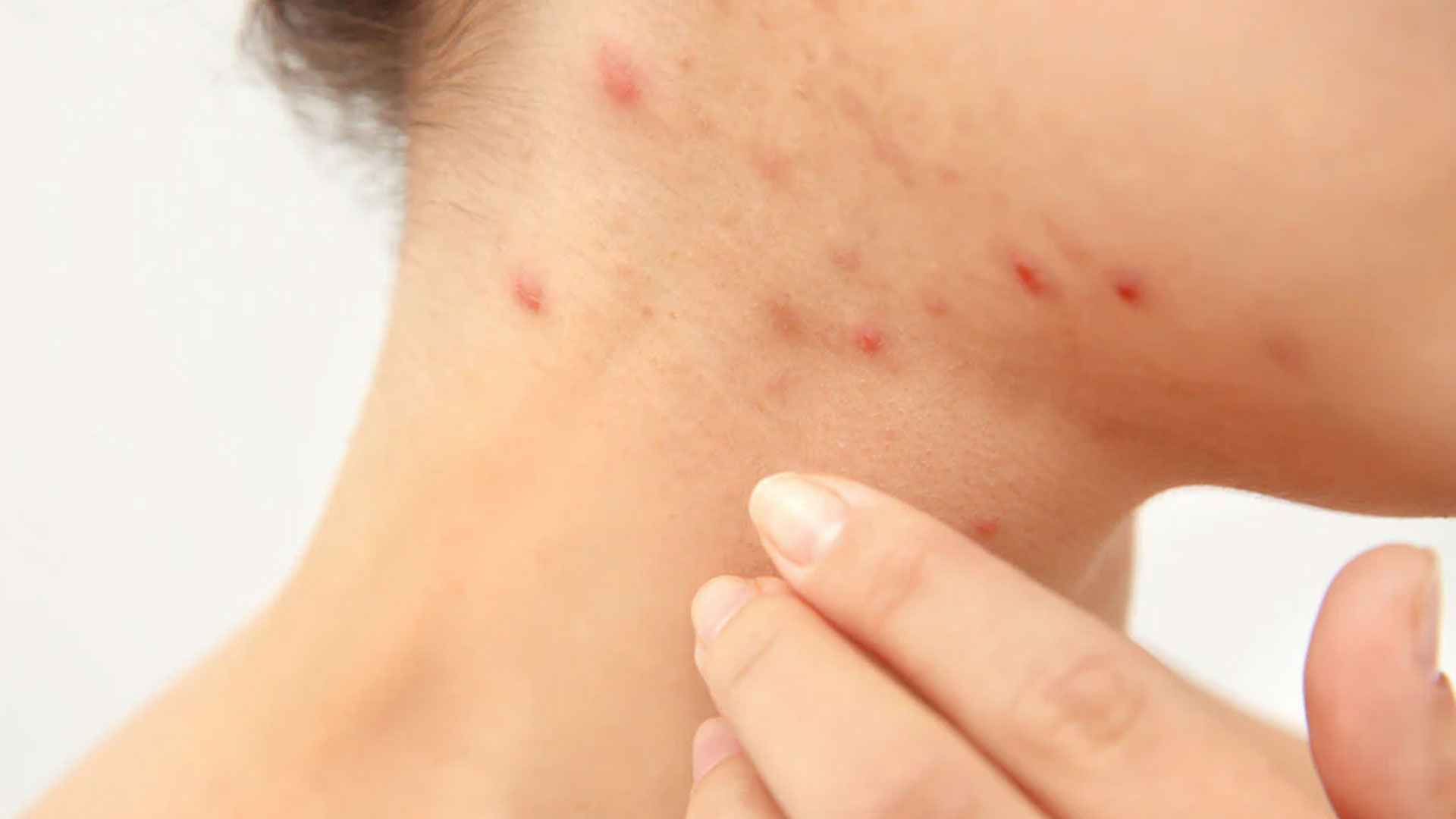 গলায় ব্রণ-ফুসকুড়ি, দূর করুন ঘরোয়া উপায়ে