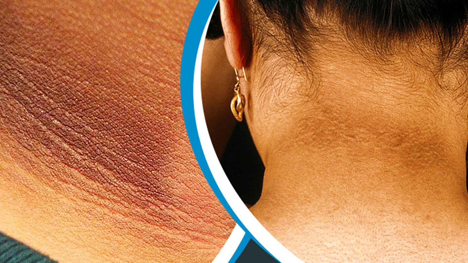 ঘাড়ের কালো দাগ দূর করার ঘরোয়া উপায়