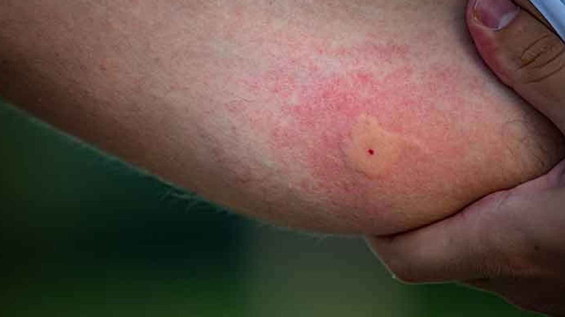 মশা কামড়ানো স্থান ফুলে যায় কেন?