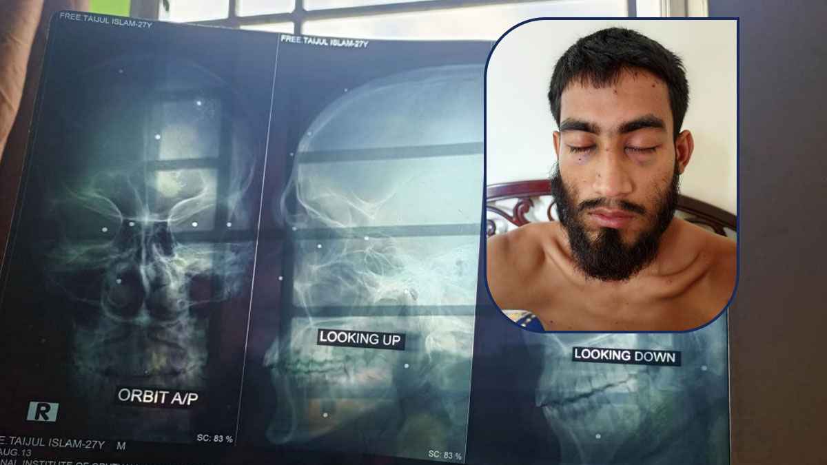 অর্থাভাবে চোখ হারানোর শংকায় তাইজুল