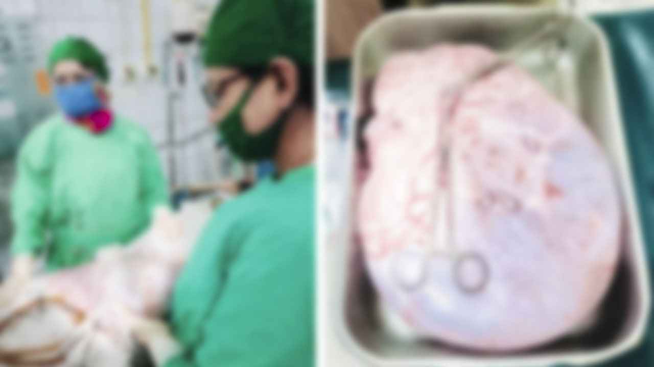 ১৪ বছরের ফাতেমার পেটে ছিল ১৫ কেজির টিউমার