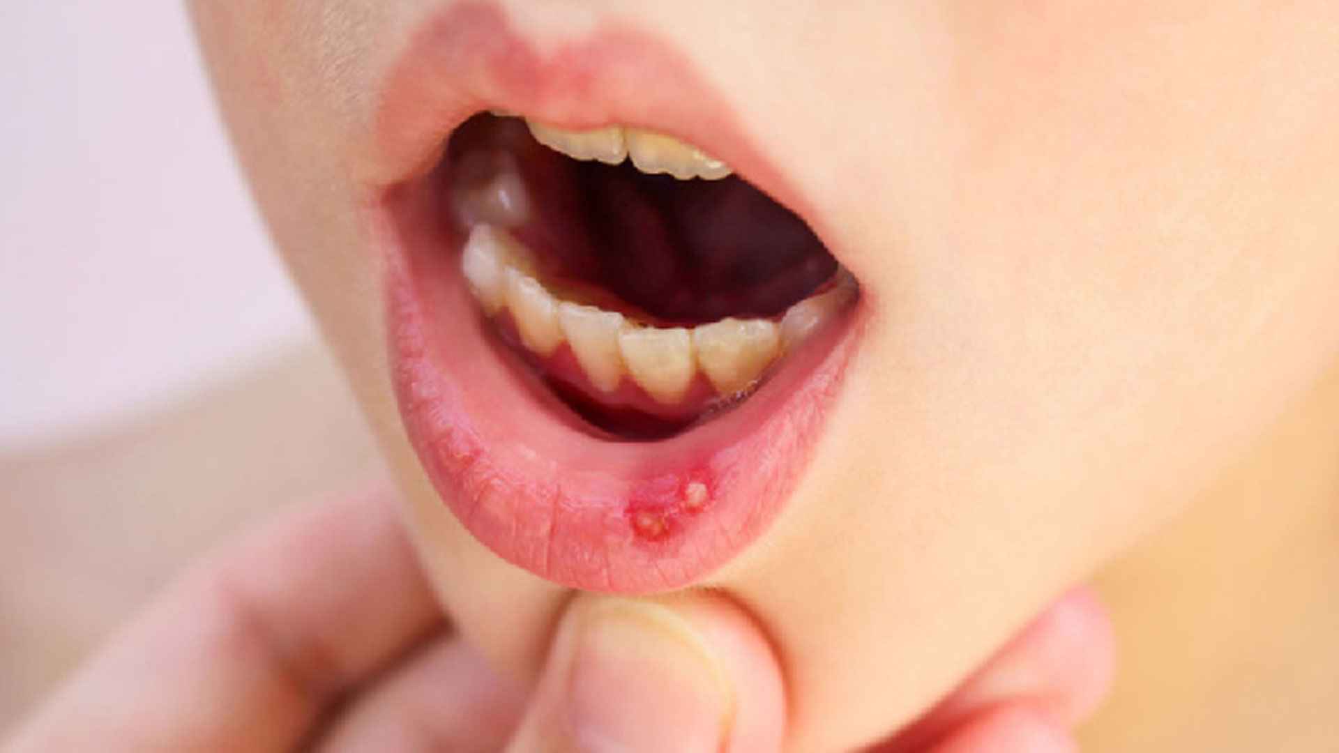 মুখে ঘা হলে করণীয়