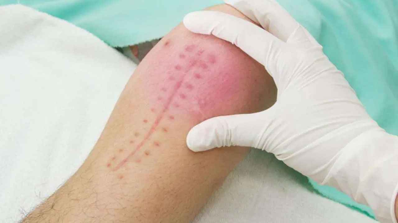 অস্ত্রোপচারের পর সেলাইয়ের জায়গায় চুলকানি? জেনে নিন কারণ ও করণীয়