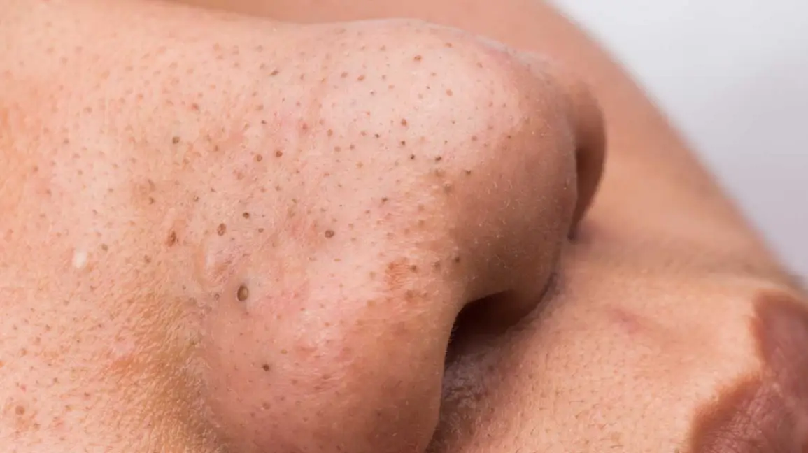 blackheads2 blackheads2