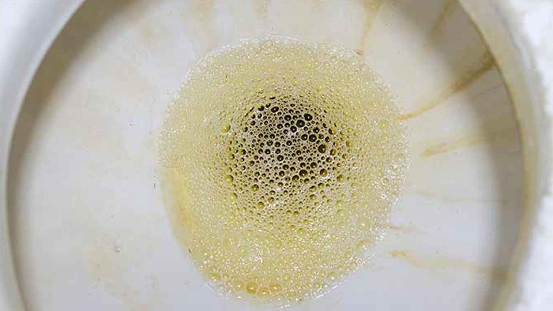 প্রস্রাবে ফেনা হলে কি দুশ্চিন্তার কিছু আছে?