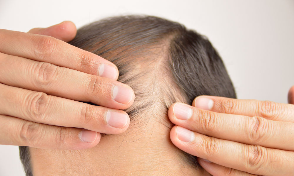 Hair-loss-and-thinning-men