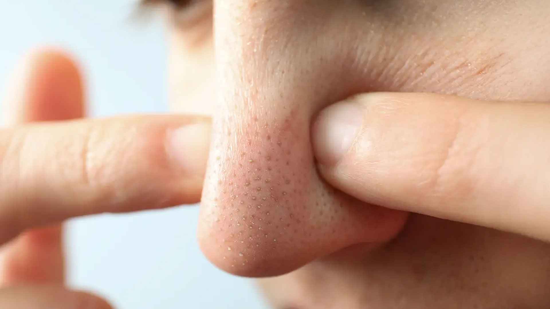 নাকের ব্ল্যাকহেডস দূর করুন সহজ ৩ উপায়ে