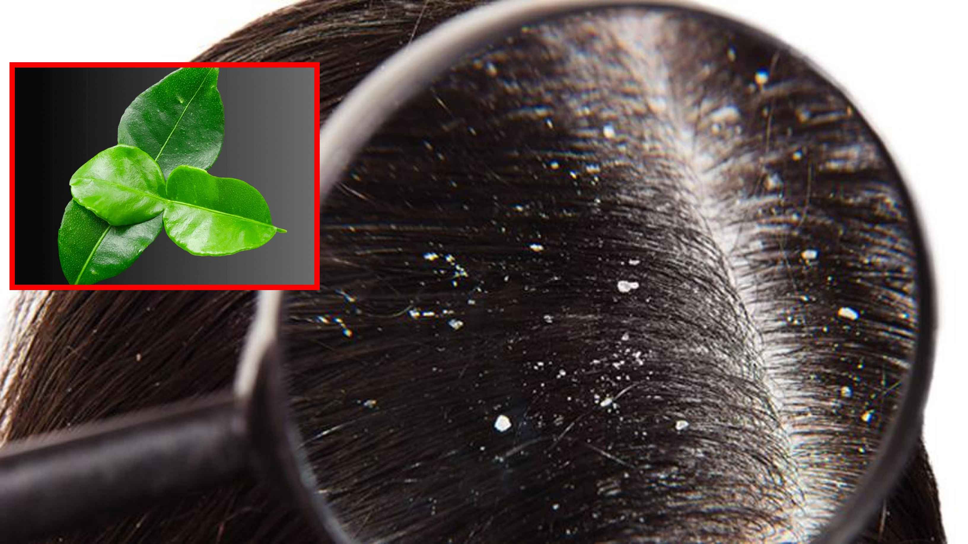 শীতে চুলের খুশকি দূর করতে ব্যবহার করুন লেবু পাতা