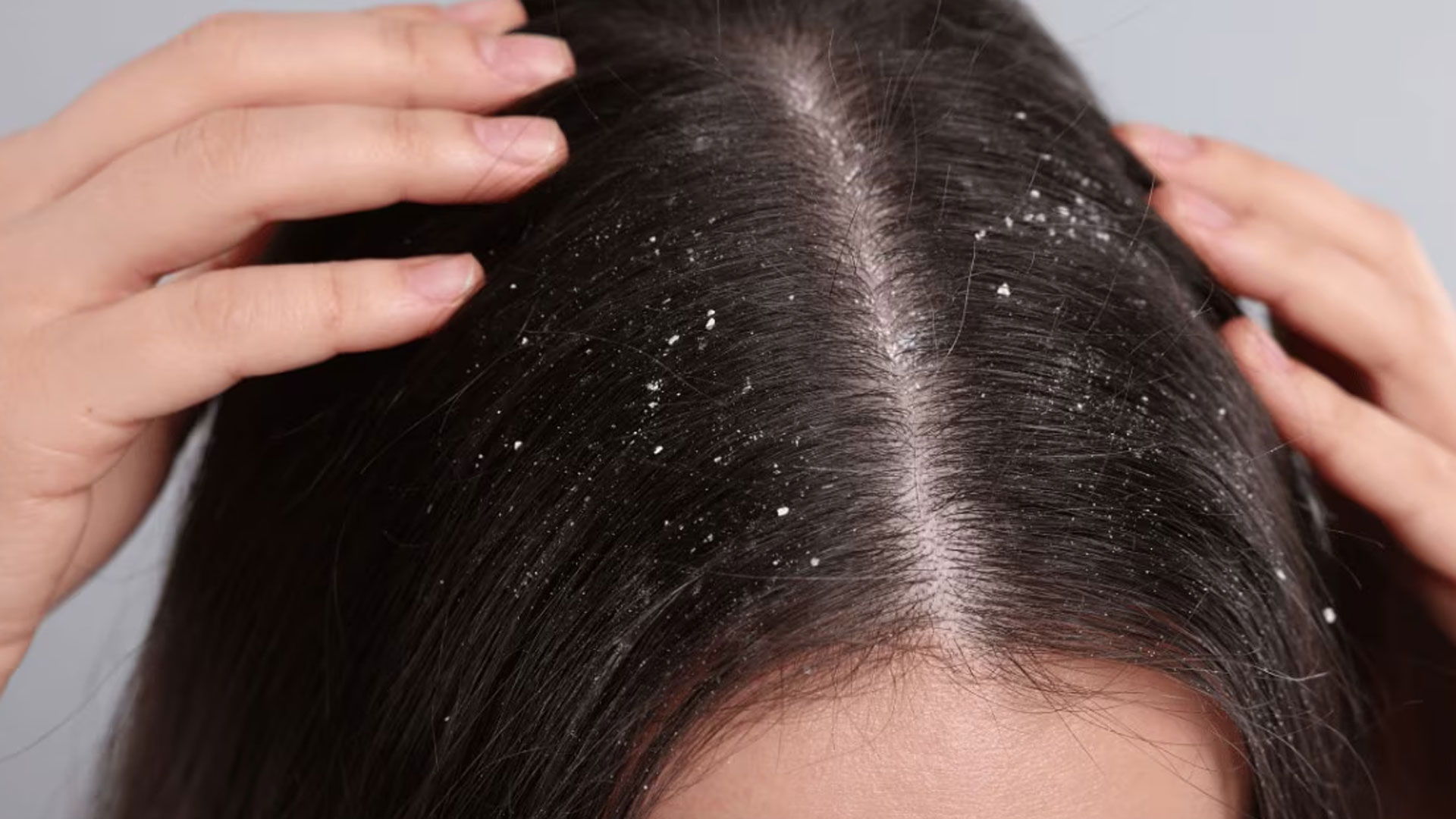 dandruff dandruff